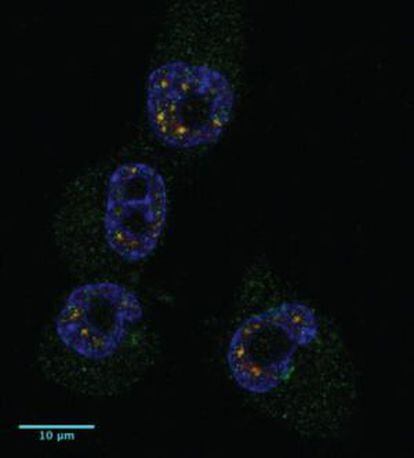 Cuatro c&eacute;lulas cancerosas. En azul, su n&uacute;cleo; en verde, las prote&iacute;nas CPEB.