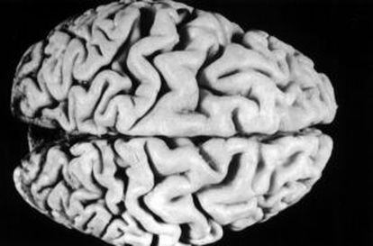 Cerebro de una persona con alzhéimer.