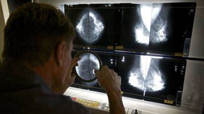 Un médico valora los resultados de una mamografía.