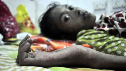 Una mujer enferma de tuberculosis, en el hospital de Agartala, en el distrito de Tripura, India.