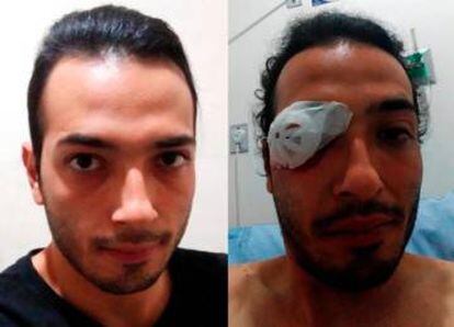 Wilmar Alexis Quiceno recibió el impacto de una granada aturdidora en Medellín el 21 de noviembre.
