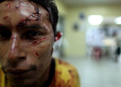 Un hombre espera ser atendido en el hospital Catalino Rivas, en San Pedro Sula, al norte de Honduras, de las heridas de un machete. El país centroamericano es uno de los lugares con más muertes violentas del mundo, de acuerdo al informe de Naciones Unidas sobre Homicidios de 2011.