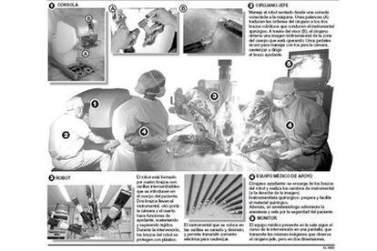 El primer robot Da Vinci, instalado en la Fundación Puigvert de Barcelona, asiste al cirujano en operaciones de próstata.