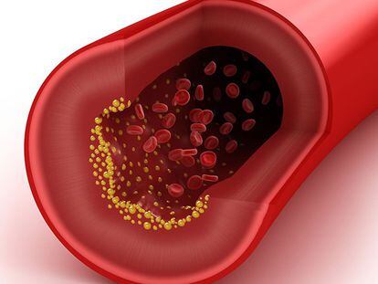 El colesterol malo obstruye los vasos sanguíneos.
