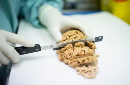 Disección de un cerebro de la Fundación CIEN, en Madrid.