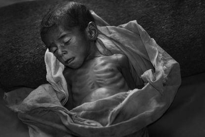Biraul, en el estado de Bihar, es una de las zonas con los índices de desnutrición más altos de la India y del mundo, al mismo tiempo que una de las áreas más pobres. Sulema Kumari tiene 9 meses y sólo pesa 2,6 kg. Su estado es muy grave, al borde del colapso debido a complicaciones intestinales. Los enfermeros y médicos indios del Hospital de Biraul tratan de estabilizarla en una carrera contra la muerte. Horas después de su ingreso, Sulema Kumari es aislada debido al alto riesgo de infección. Las complicaciones de este tipo, en organismos tan débiles, son la principal causa de mortalidad en pacientes de esta edad.
