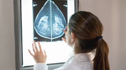 En 2022 se diagnosticaron 33.000 casos de cáncer de mama en España. Es el tumor más frecuente en las mujeres, pero también uno de los de mejor pronóstico, gracias a su diagnóstico precoz, al tratamiento personalizado y a la investigación.