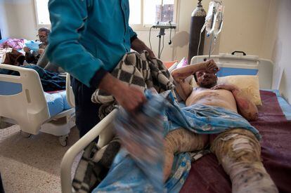 Varios civiles sirios son atendidos en 2013 en el hospital informal de Arsal de quemaduras graves tras un atentado con coche bomba en la ciudad siria de Rankus.