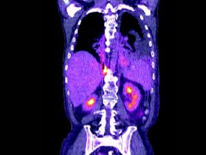 Tomografía de un cáncer de pulmón.