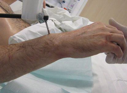 Un paciente recibe dos brazos de un fallecido en el hospital en Munich, Alemania
