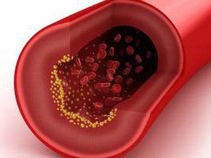 Representación de un vaso sanguíneo con colesterol.