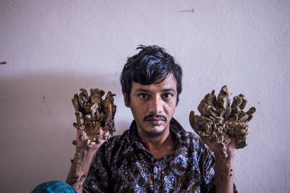 Abul Bajandar, de 28 años, apodado El hombre árbol por sus verrugas en sus manos y pies, en el Hospital de la Facultad de Medicina de Dhaka, en Bangladés. Frustrado por empeoramiento de la condición, hoy ha afirmado que quiere amputar sus manos para aliviar el "dolor insoportable" que padece.