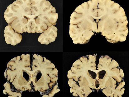 Un cerebro normal, arriba, y uno con CTE nivel 4, en una imagen del estudio.