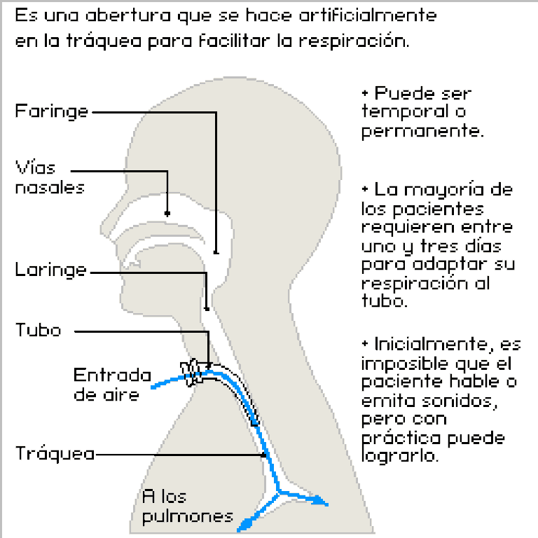 La Traqueotomía | Internacional | EL PAÍS