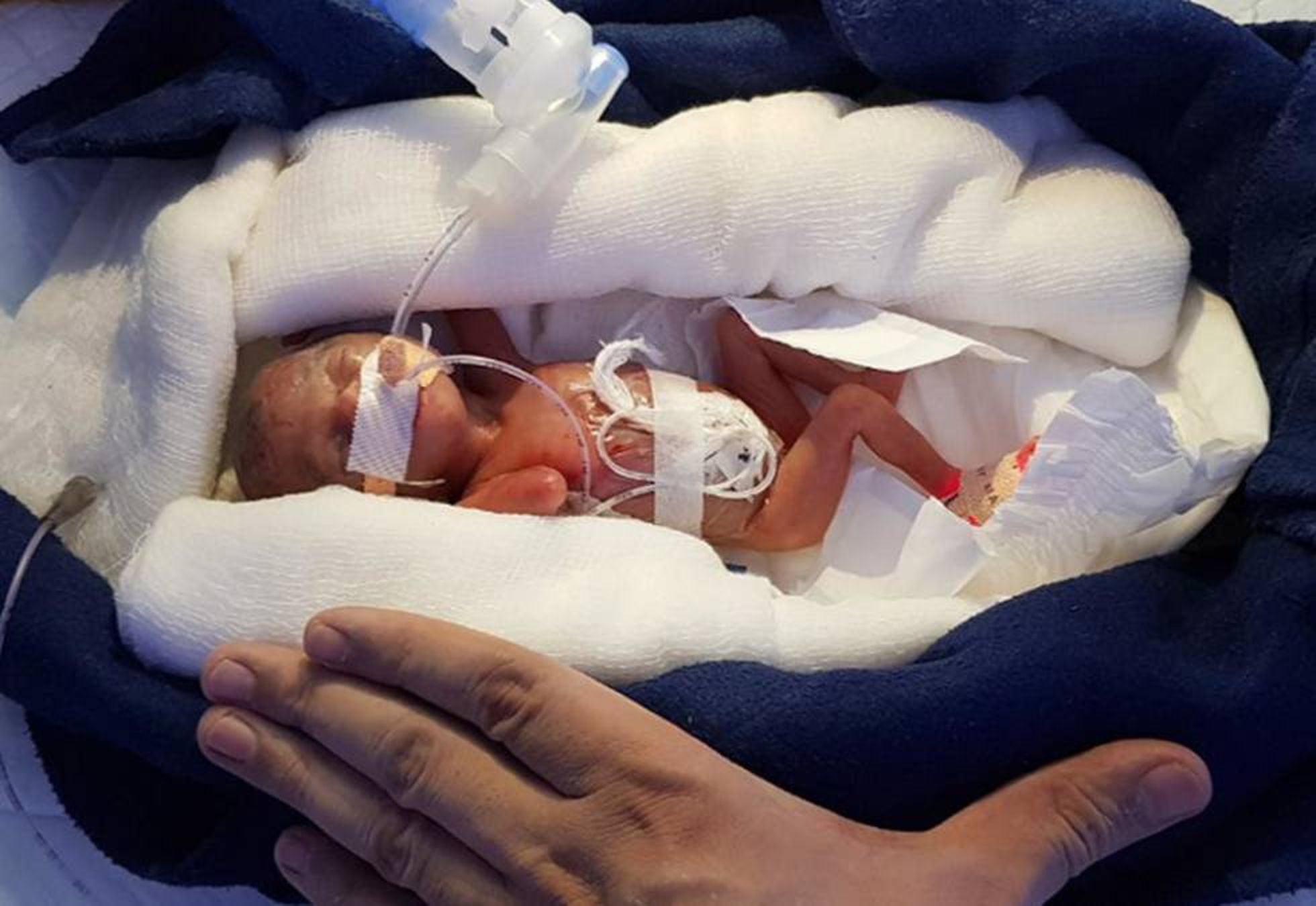 Una Bebe Logra Sobrevivir Tras Nacer Con 400 Gramos A Las 28 Semanas Mamas Papas El Pais