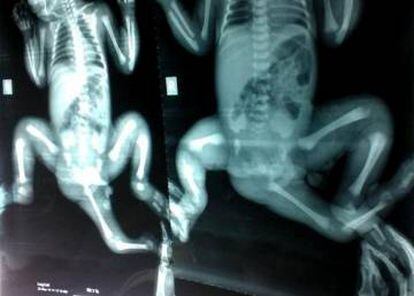 Radiografía de la niña antes de ser operada.