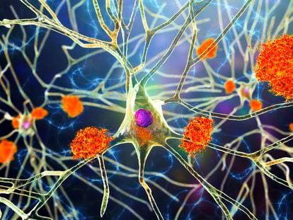 Ilustración de placas de amiloide de la enfermedad de alzhéimer en neuronas.