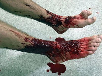 Foto de los pies de Sam Kanizay tras el ataque, facilitadas por su padre.