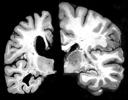 Comparaci&oacute;n del cerebro de una persona con alzh&eacute;imer, a la izquierda, y otra sana