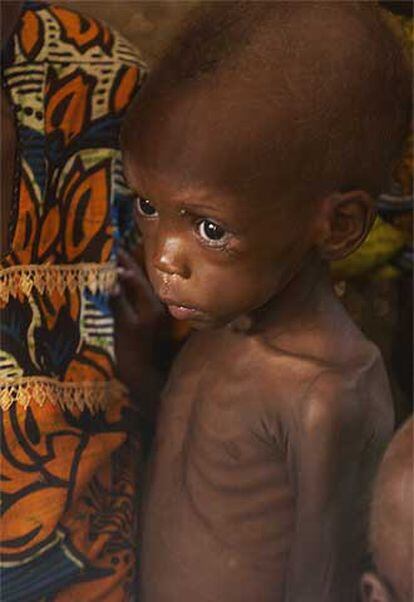 Un niño desnutrido en Níger, uno de los cinco países más pobres.