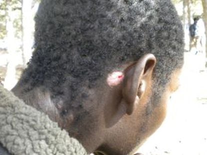 El camerunés Nleha Ramses muestra una herida producida, supuestamente, por golpes de la policía marroquí