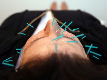 Un hombre recibe una sesión de acupuntura.