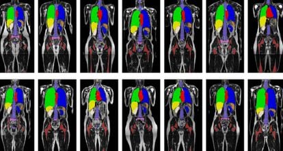 Escáneres de pacientes sobre los que el sistema de visión artificial identifica los órganos que pueden verse afectados por la radioterapia.