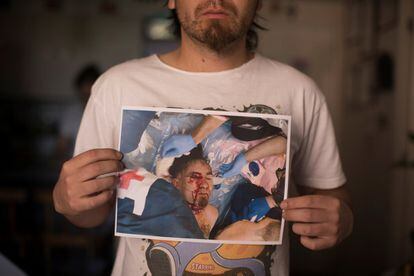 Ybar Soto, de 29 años, posa en su casa en Santiago de Chile. Él perdió la visión total en el ojo luego de ser herido con un perdigón.