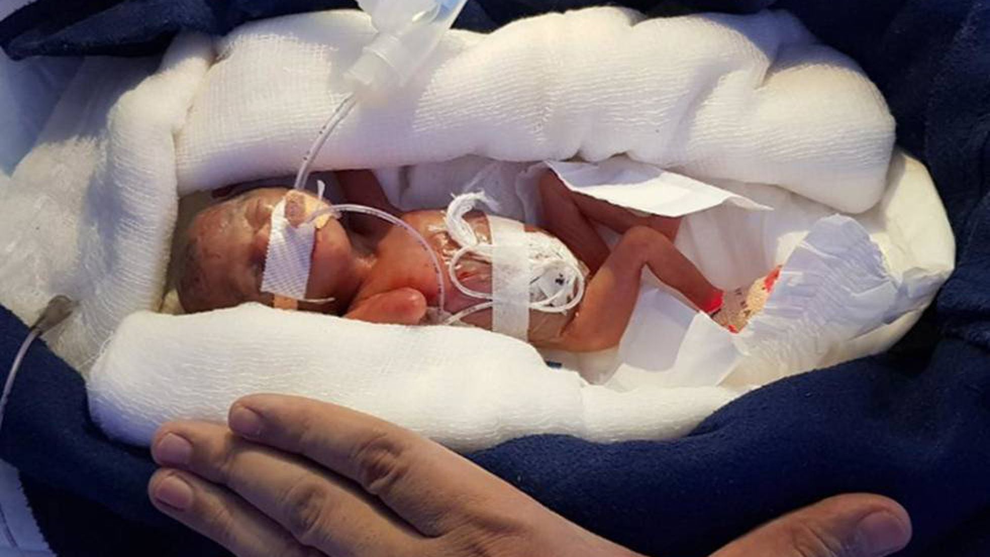 Propuesta alternativa Bungalow Centro de la ciudad Una bebé logra sobrevivir tras nacer con 400 gramos a las 28 semanas |  Mamas & Papas | EL PAÍS