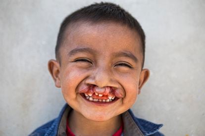 Gabo, de cuatro años, sonríe a cámara días antes de su operación. Su familia ha estado esperando esta intervención desde que nació.  