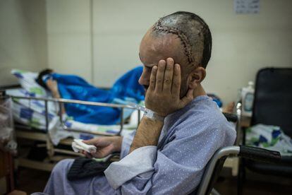 Alan, un sirio de la región de Quneitra que ha sufrido graves heridas de metralla en la cabeza, en el hospital israelí de Nahariya.