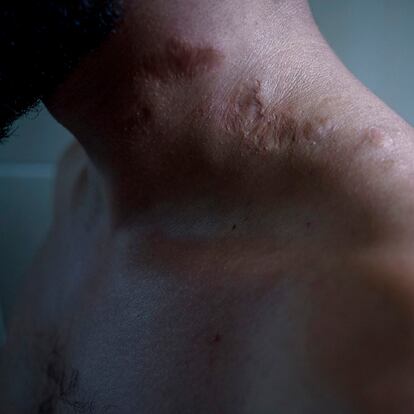 El cuerpo de Mohammad salpicado de pequeñas heridas provocadas por descargas eléctricas.