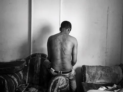 Un solicitante de asilo eritreo en El Cairo muestra su espalda con cicatrices. Los traficantes egipcios lo torturaron goteando plástico fundido en su espalda para pedir un rescate en la península del Sinaí en mayo de 2013.