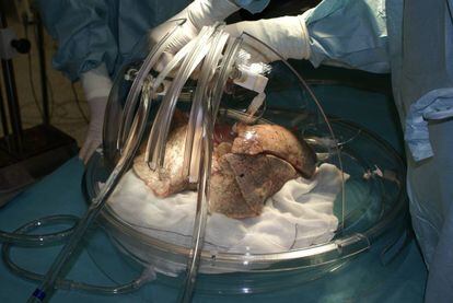 Un trasplante de pulm&oacute;n en 2010, en el Hospital Puerta de Hierro de Madrid.