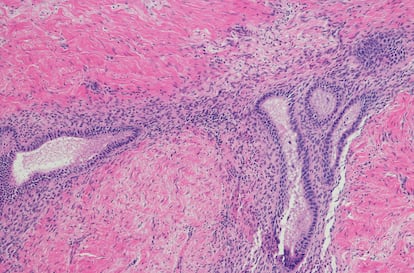 La endometriosis se produce cuando el revestimiento del útero crece fuera de sitio, en sitios como los ovarios, el peritoneo o el intestino.