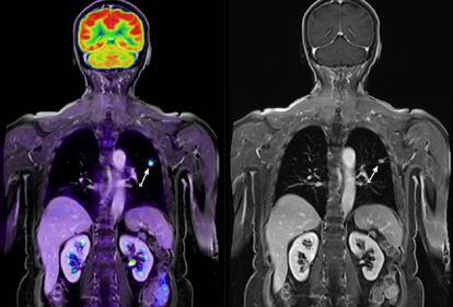 Imágenes médicas de un paciente con cáncer de pulmón.