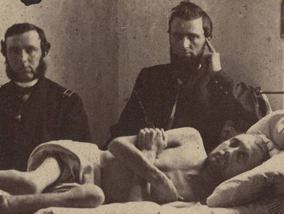 El cabo Calvin Bates, en el hospital tras salir del campo de prisioneros confederado de Andersonville. Atención, la foto ampliada puede herir su sensibilidad.