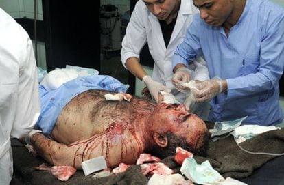 Un herido recibe atenci&oacute;n m&eacute;dico en Damasco tras un ataque con explosivos. 