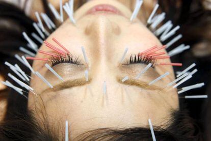 La acupuntura es eficaz para tratar n&aacute;useas y cefaleas.