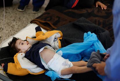 Ahmed Qannan, un niño palestino que sufre malnutrición, es atendido en un centro de salud en Rafah, al sur de la franja de Gaza, el lunes 4 de febrero. 
