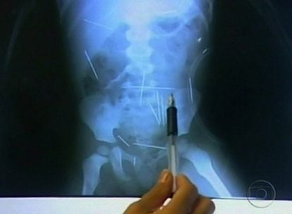 Foto de la radiografía realizada al pequeño donde se ven algunas de las agujas que tiene introducidas en su cuerpo