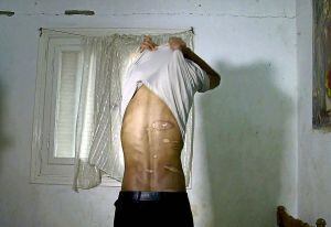 Un superviviente del cautiverio en la península del Sinaí muestra las secuelas en su cuerpo.