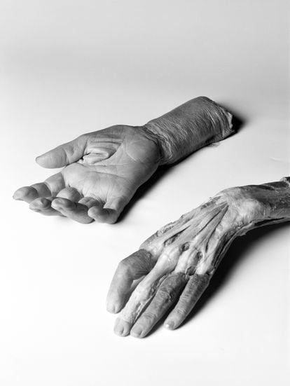 'Two hands prepared for forensic study'.