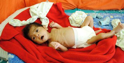 El 54% de los guatemaltecos menores de cinco años sufre desnutrición crónica, según Unicef.