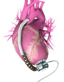 Recreación gráfica de cómo queda colocado el modelo HVAD de corazón artificial permanente.