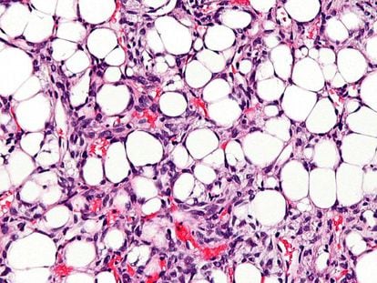 Un tejido con liposarcoma. Los c&iacute;rculos blancos son los ac&uacute;mulos de grasa.