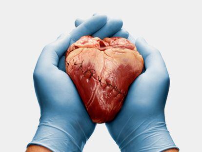 La cardiomiopatía dilatada es uno de los motivos de trasplante de corazón.