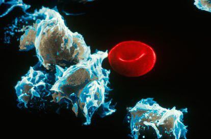 Células con leucemia (izquierda) junto a un glóbulo rojo.