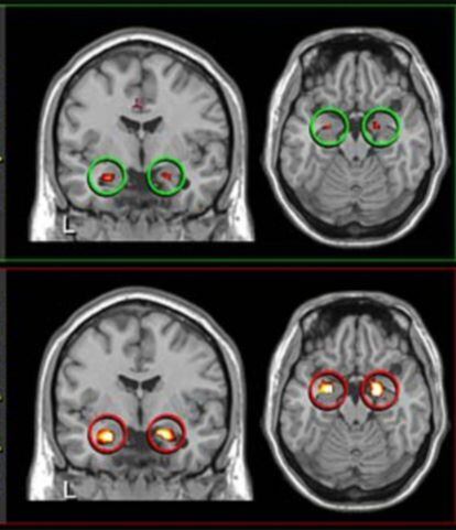 Imágenes del cerebro en que se observa la respuesta de la amígdala (arriba, marcada en verde) de personas que han dormido normalmente una noche y (abajo, en rojo) de personas que realizan la misma actividad mental tras 35 horas en vela