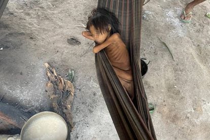 Niña Yanomami con desnutrición y malaria, en la aldea de Maimasi, Brasil